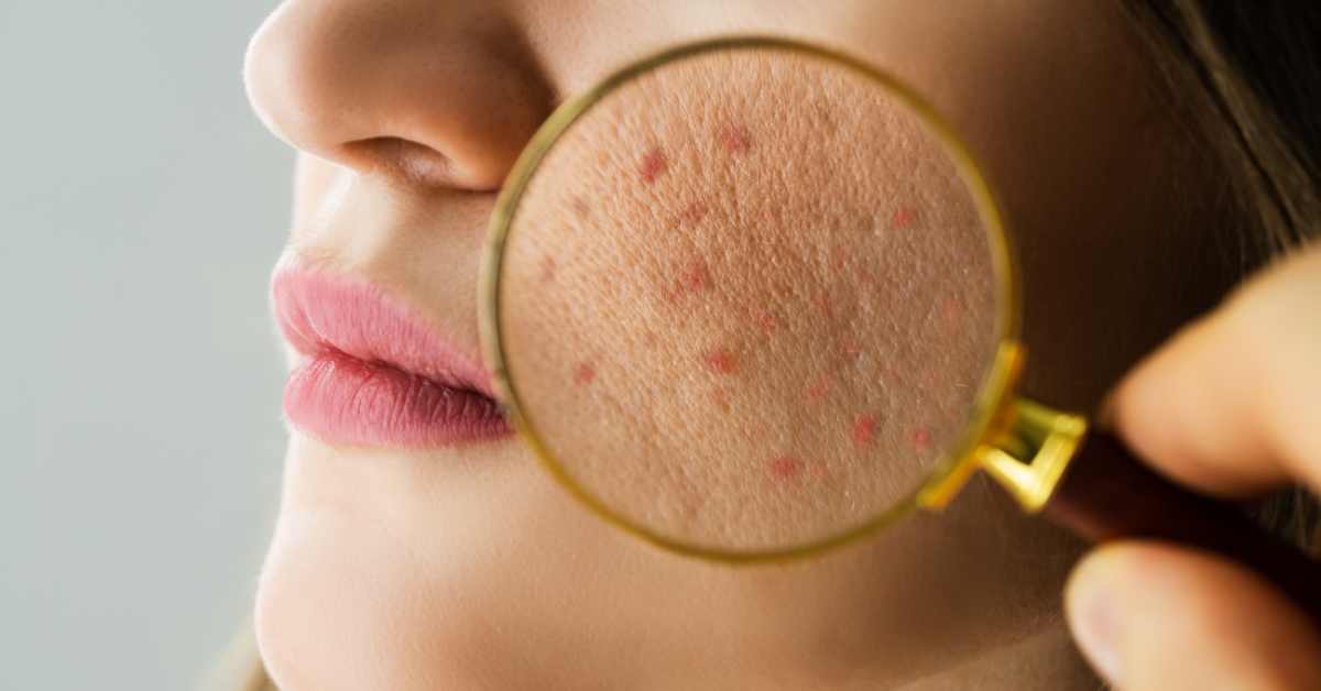 Apakah Serum Vitamin C Bagus Untuk Kulit Berjerawat?