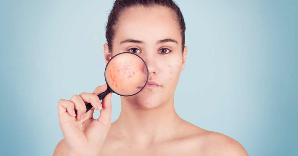 Apakah Vitamin E Cocok untuk Kulit Berjerawat?